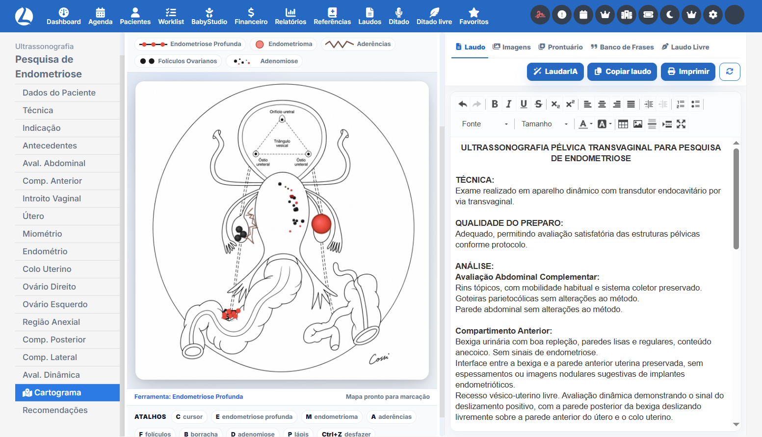 Mapeamento de endometriose profunda
